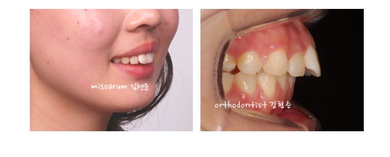 세라믹교정 가격 4대부작용 관련 이미지 3