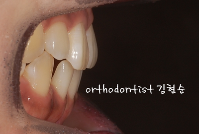 치열 교정 ( 벌어짐 ) 관련 이미지 6
