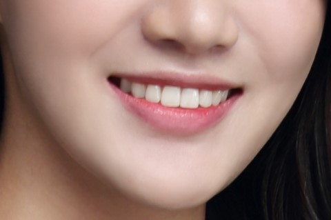 치아의 배열을 개선, 발치하지 않고 교정하기 관련 이미지 1