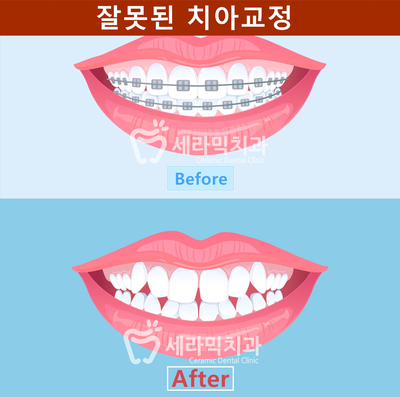 투명치아교정 부작용과 부실 진료? 관련 이미지 3