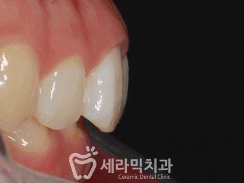 딥바이트(과개교합) 때문에 감추고 싶던 치아, 치아교정전후 달라진 미소 관련 이미지 8