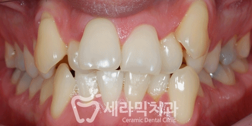 치열불규칙 치아교정으로 활짝 웃게 된 치아교정전후 관련 이미지 3