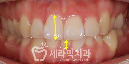 돌출입과 과개교합, 중심선 불일치, 치열불규칙 치아교정전후사진 관련 이미지 3