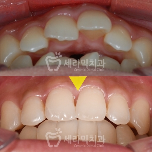 Open Bite Dental Clinic Orthodontic Before and After: Did a Long-Looking Jaw Become Shorter? image 9