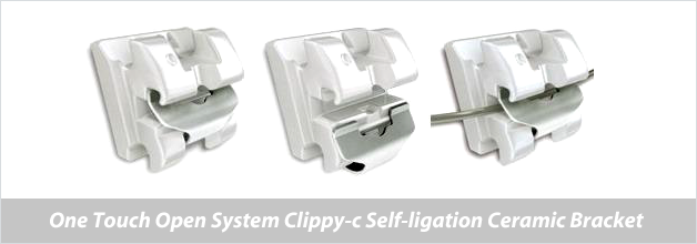 세라믹교정 세라믹치과 클리피씨교정 이야기 관련 이미지 11