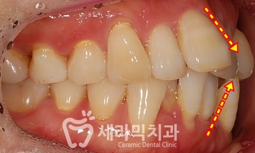 40대에 이어 50대 치아교정 전후사례 증가 추세 관련 이미지 6