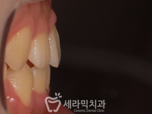돌출입교정으로 갸름한 턱라인까지 되찾다! 돌출입 치아교정전후 관련 이미지 24