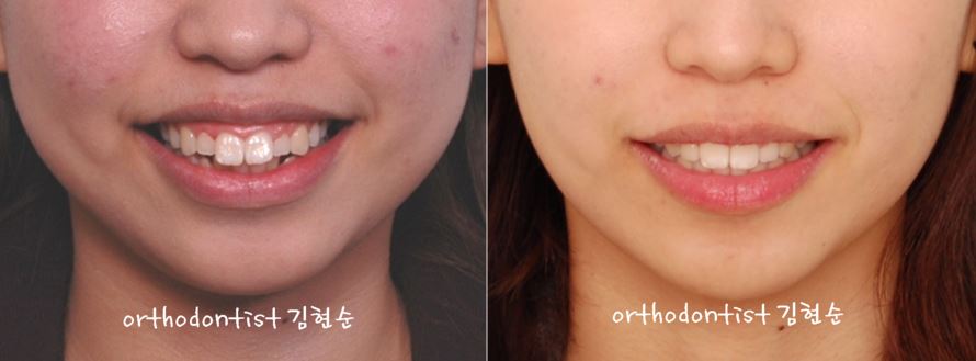 세라믹치과 "돌출입 발치교정" 관련 이미지 10