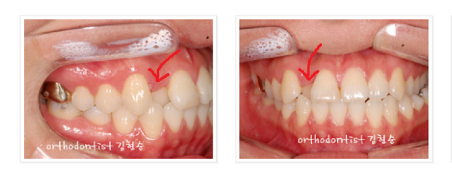 안면비대칭 교정, 치아교정만으로 간단히 해결하기 관련 이미지 7