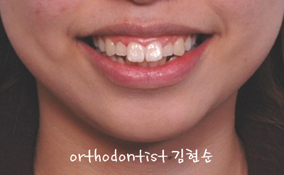 강남 돌출 관련 이미지 3