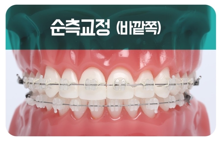 세라믹교정 클리피씨 데이몬 차이점 요약 관련 이미지 14