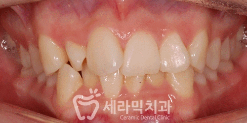 발치없이 치열불규칙교정으로 세련된 미소 완성! 관련 이미지 3
