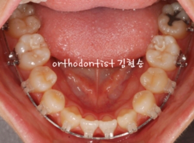 강남교정치과 관련 이미지 22