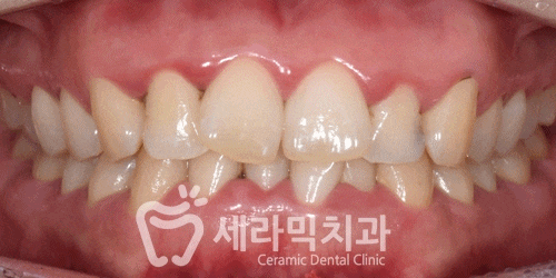 과개교합과 삐뚤빼뚤한 치열, 돌출입 앞니 치아교정전후 관련 이미지 4