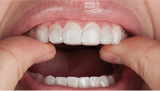 연말 치아미백 이벤트 , 학동역 세라믹치과 관련 이미지 4