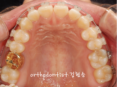 치열 교정 ( 벌어짐 ) 관련 이미지 18