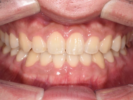 치아가 반대로 물리는 관련 이미지 11