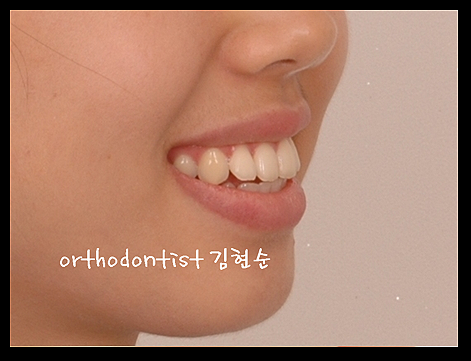 강남교정치과 관련 이미지 35