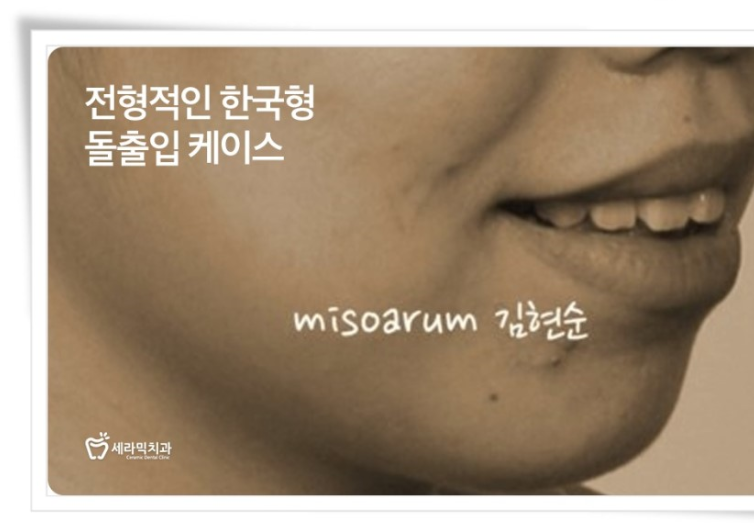 세라믹치과 돌출입교정 투명교정기로 ~ 관련 이미지 3