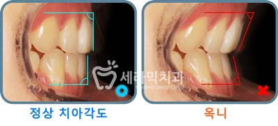 토끼이빨 돌출입 치아교정 전후 표정변화! 관련 이미지 10