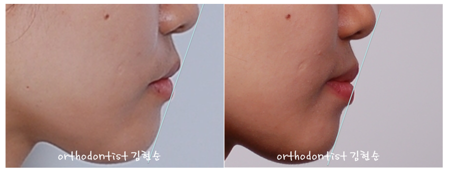 비발치로 덧니의 치열을 개선, 중심선을 맞추는 교정. 관련 이미지 6