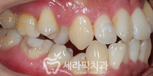 삐뚤빼뚤 틀어지고 불규칙한 치아배열 치아교정전후 관련 이미지 2