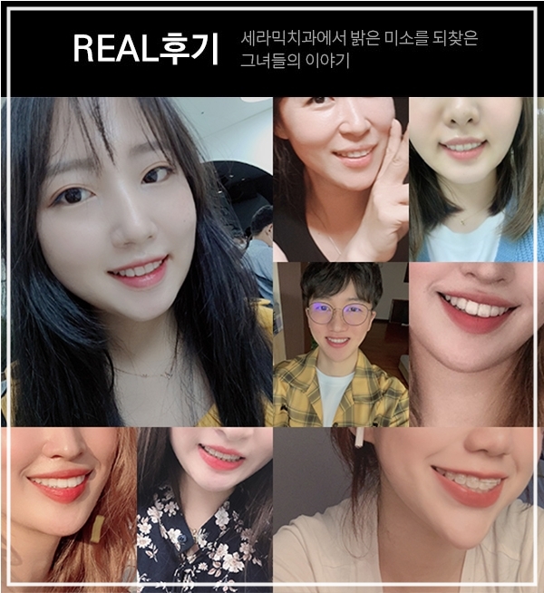 돌출입교정만 했을 뿐인데, 얼굴형과 무턱까지 개선된 치아교정전후 관련 이미지 9