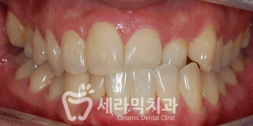 세라믹치과 치아교정전후 : 앞니반대교합+치열불규칙 관련 이미지 8