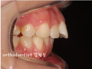 강남 돌출입 교정 관련 이미지 15