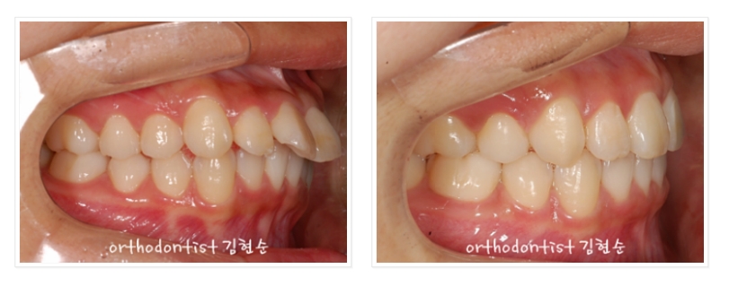 세라믹교정 은 세라믹치과 발치비발치 해결 관련 이미지 9