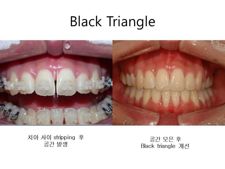 학동역치과 치아교정 잘하는 곳 ! 관련 이미지 28