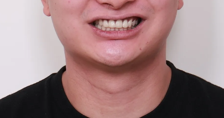 20대 남성의 토끼이빨 교정 – 소구치 발치 없이 관련 이미지 12