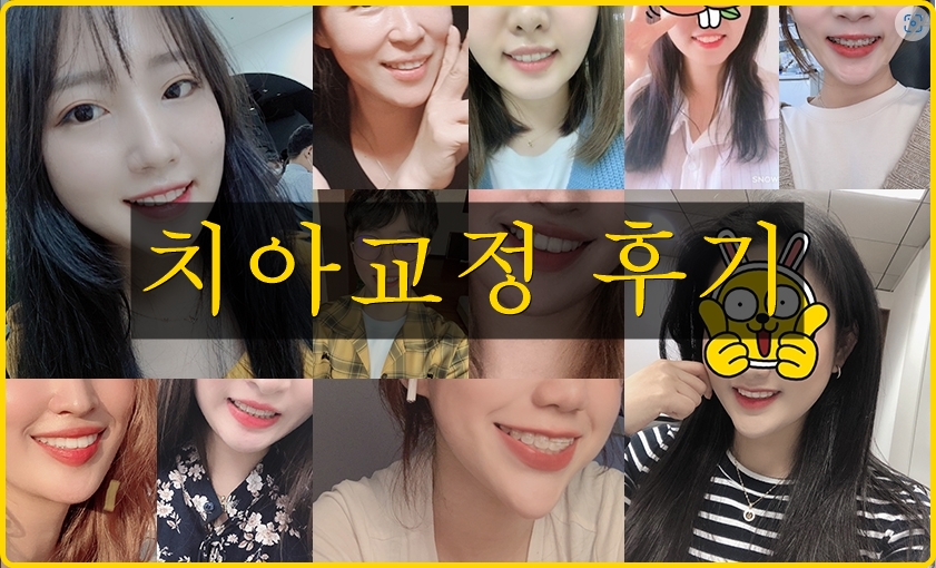 얼굴 비대칭 치아교정전후, 수술 없이 얼마나 개선될까요? 관련 이미지 5