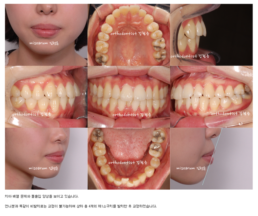 세라믹교정 세라믹치과-돌출입 발치교정 11 관련 이미지 2