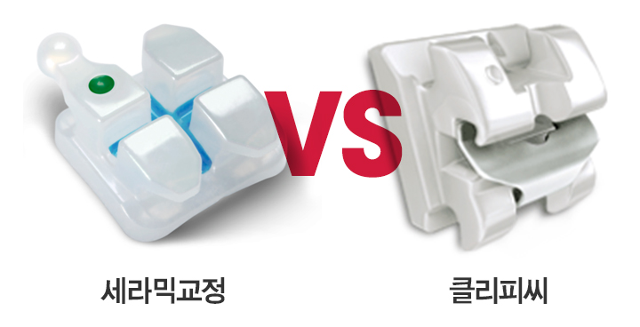 강남치아교정 브라켓비교분석 관련 이미지 5
