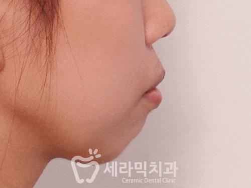 치아교정 전후 : 돌출입과 무턱교정으로 세련된 옆 라인 완성! 관련 이미지 1