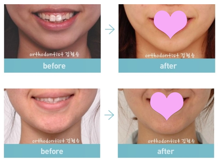 비발치교정 무조건 좋은 것만은 아니다? 관련 이미지 7