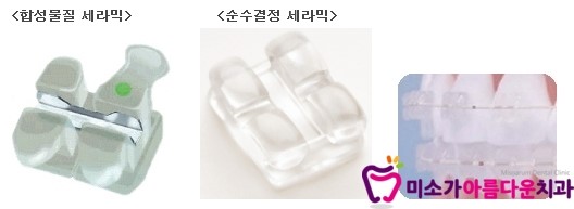 강남교정전문치과 미소가아름다운치과의 세라믹교정 [세라믹교정,강남세라믹교정,미소가아름다운치과] 관련 이미지 2