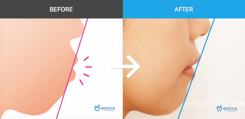 학동역치과 미국3M교정 추천 ~~ 관련 이미지 16