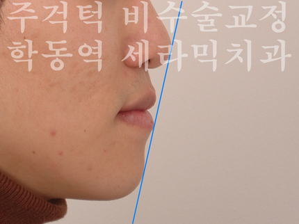 주걱턱 비수술 치아교정 잘하는 학동역 세라믹치과 관련 이미지 6