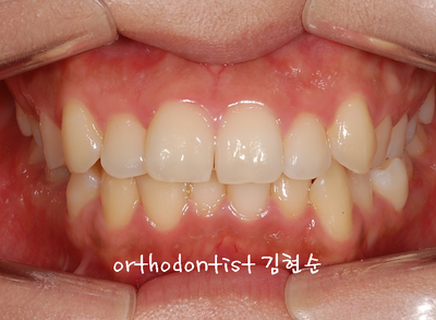 강남 돌출 관련 이미지 9