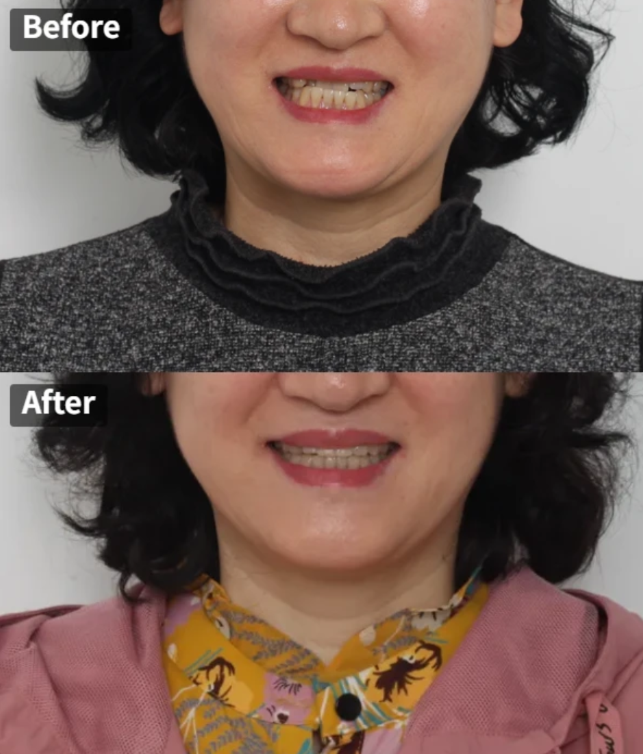 50대 치아교정 사례: 평생의 콤플렉스였던 앞니 반대교합 관련 이미지 13