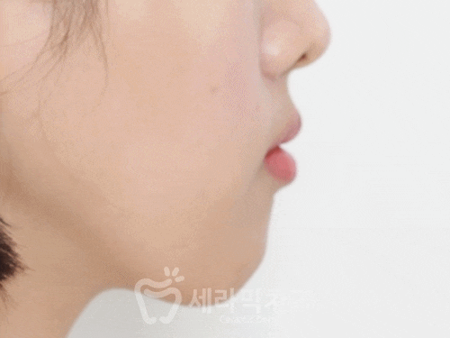 Open Bite Dental Clinic Orthodontic Before and After: Did a Long-Looking Jaw Become Shorter? image 11