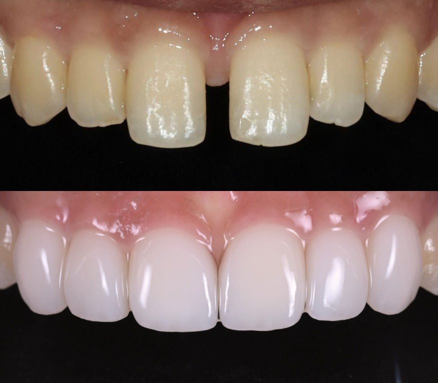 앞니 벌어짐, 교정 없이 라미네이트로 해결한 경우 관련 이미지 1