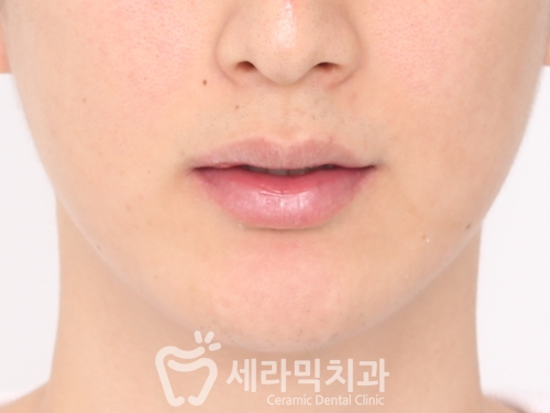 치열불규칙 치아교정으로 활짝 웃게 된 치아교정전후 관련 이미지 2