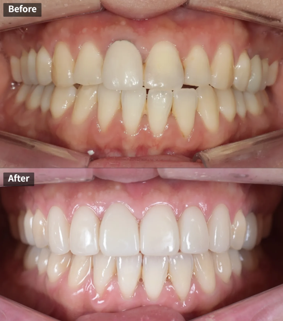 A Case of Improving the Smile Line Along with Replacing a Front Tooth Crown image 1