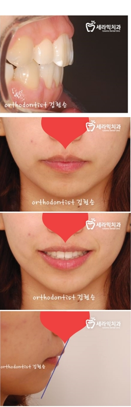 학동역 돌출입교정 세라믹치과 관련 이미지 13