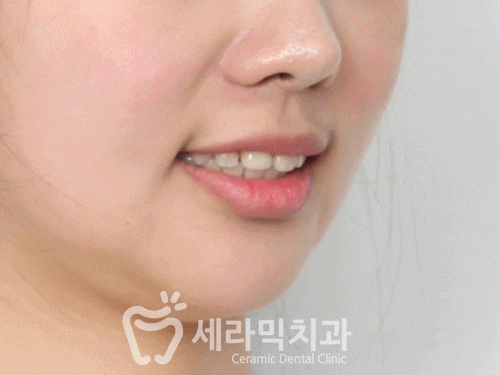 돌출입 치아벌어짐 치아재교정 전후. 세라믹치과 관련 이미지 9