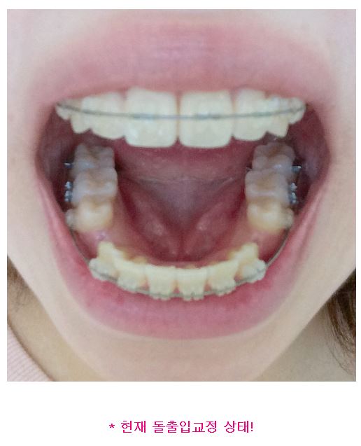 세라믹치과 홍수빈님 다시교정하기 관련 이미지 6