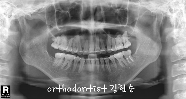 치열 교정(치열 불규칙) 관련 이미지 33